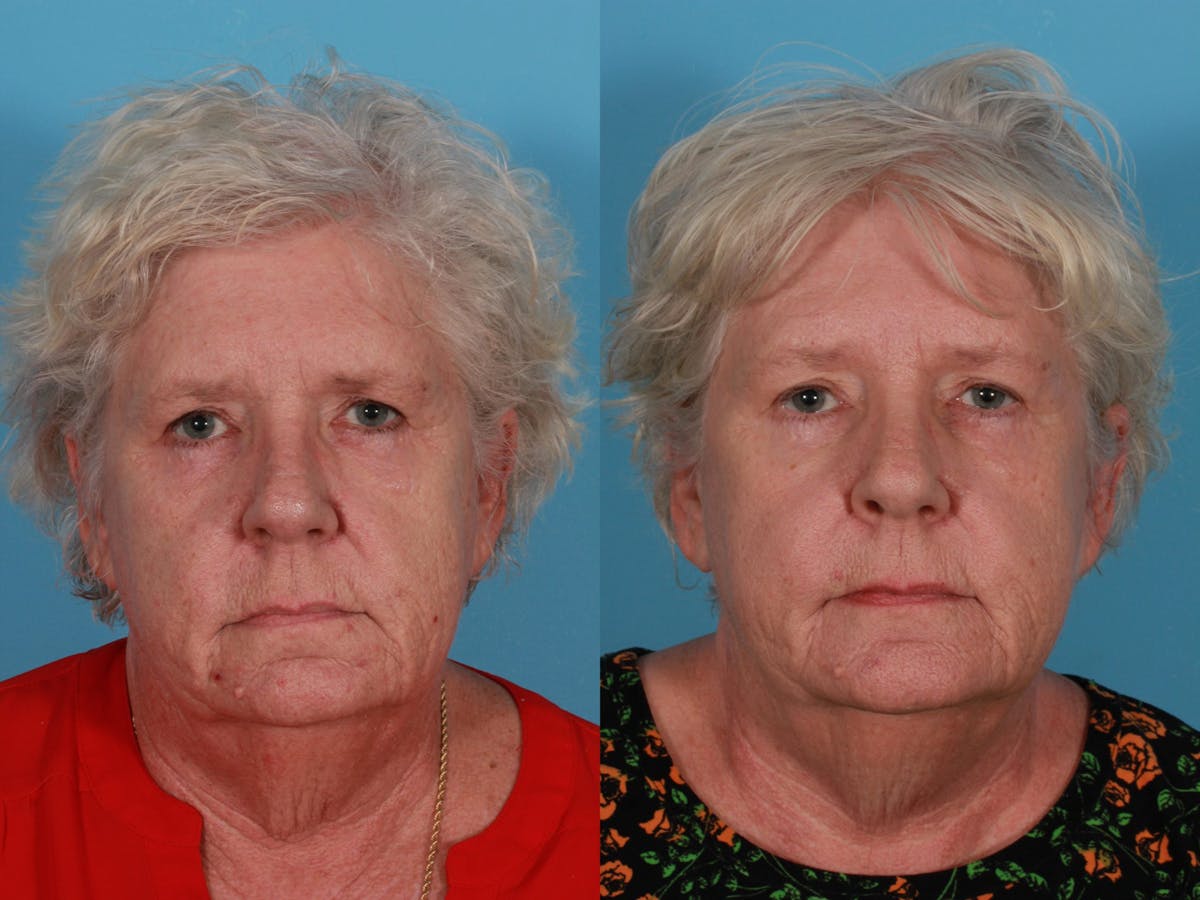 Lasers Before & After Gallery - Patient 326154 - Image 4