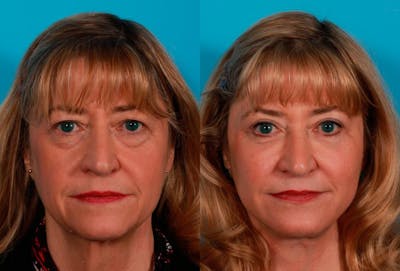 Facial Fat Transfer Before & After Gallery - Patient 869640 - Image 1