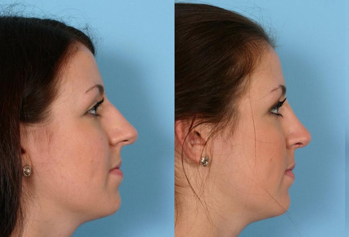 Rhinoplasty Before & After Gallery - Patient 558721 - Image 2