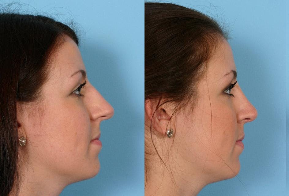 Rhinoplasty Before & After Gallery - Patient 558721 - Image 2