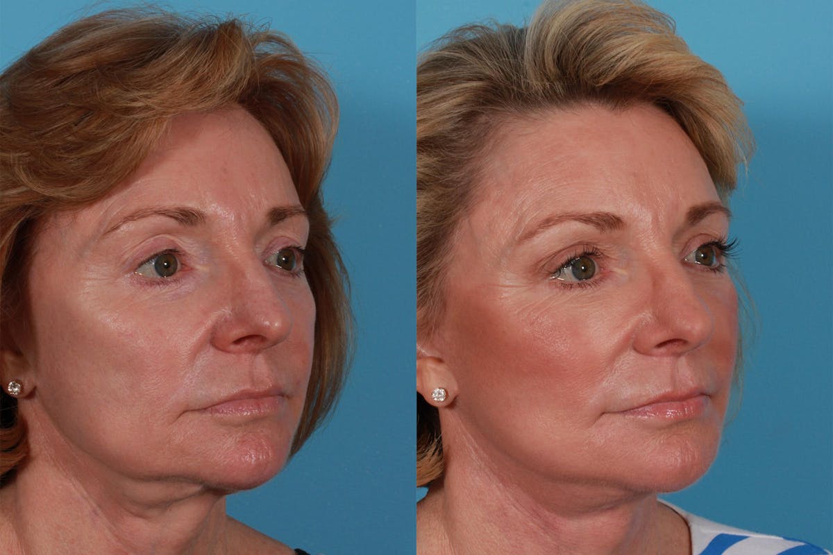 Facelift Before & After Gallery - Patient 325466 - Image 2