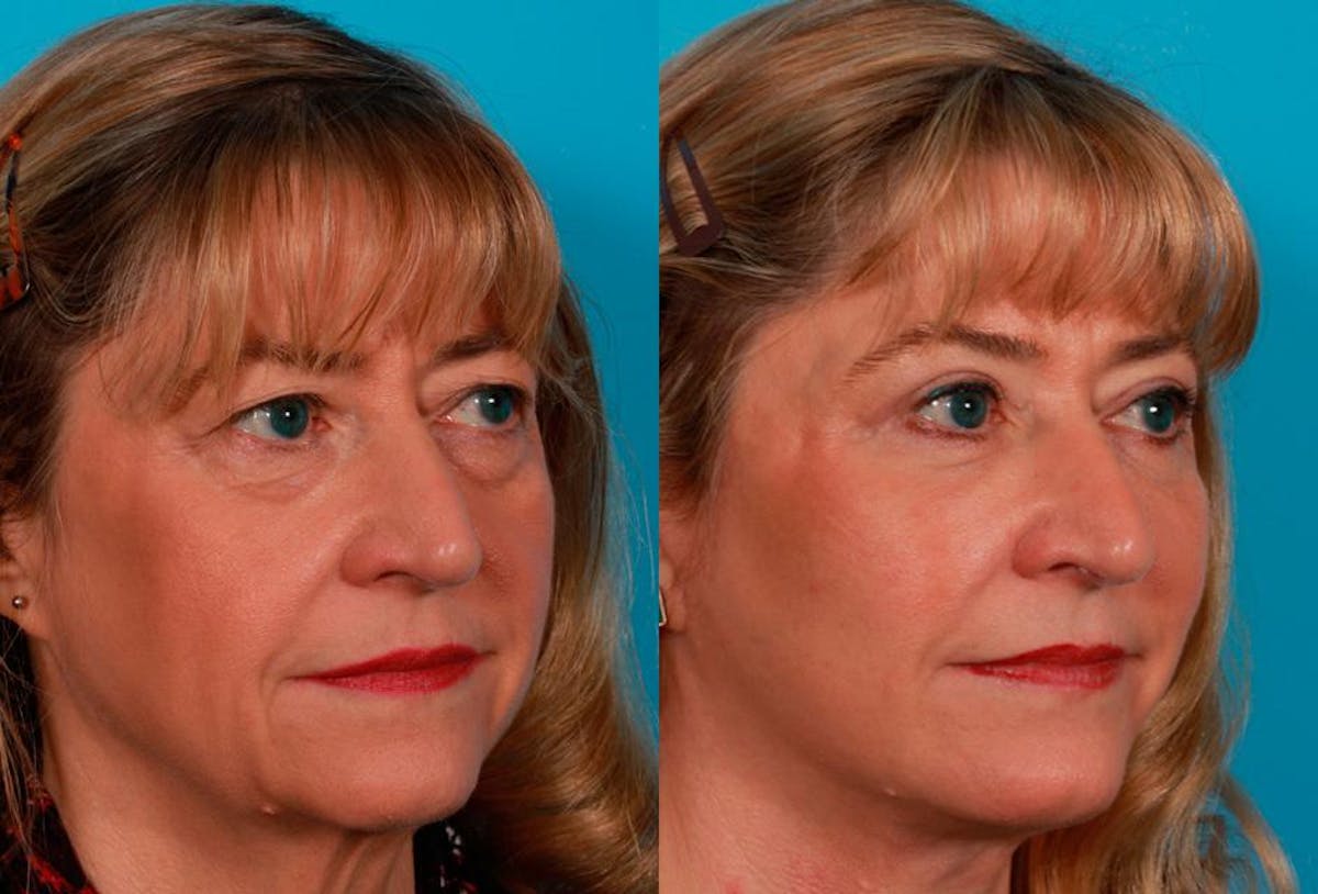 Facial Fat Transfer Before & After Gallery - Patient 869640 - Image 2