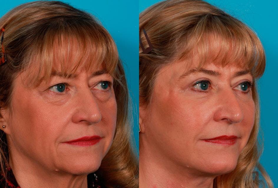 Facial Fat Transfer Before & After Gallery - Patient 869640 - Image 2