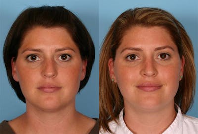 Rhinoplasty Before & After Gallery - Patient 389866 - Image 1