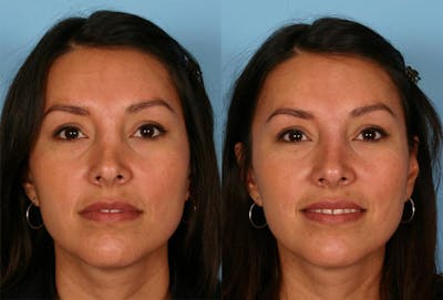 Restylane Before & After Gallery - Patient 803261 - Image 1