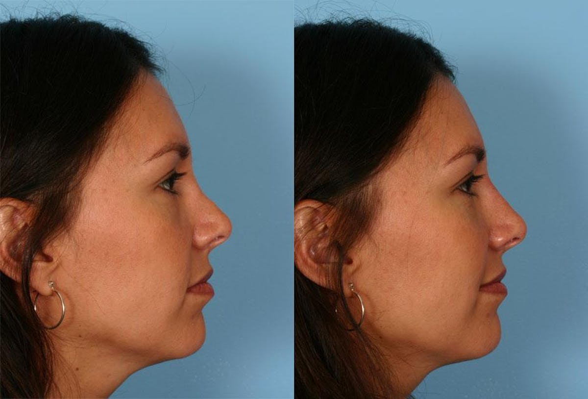 Restylane Before & After Gallery - Patient 803261 - Image 2