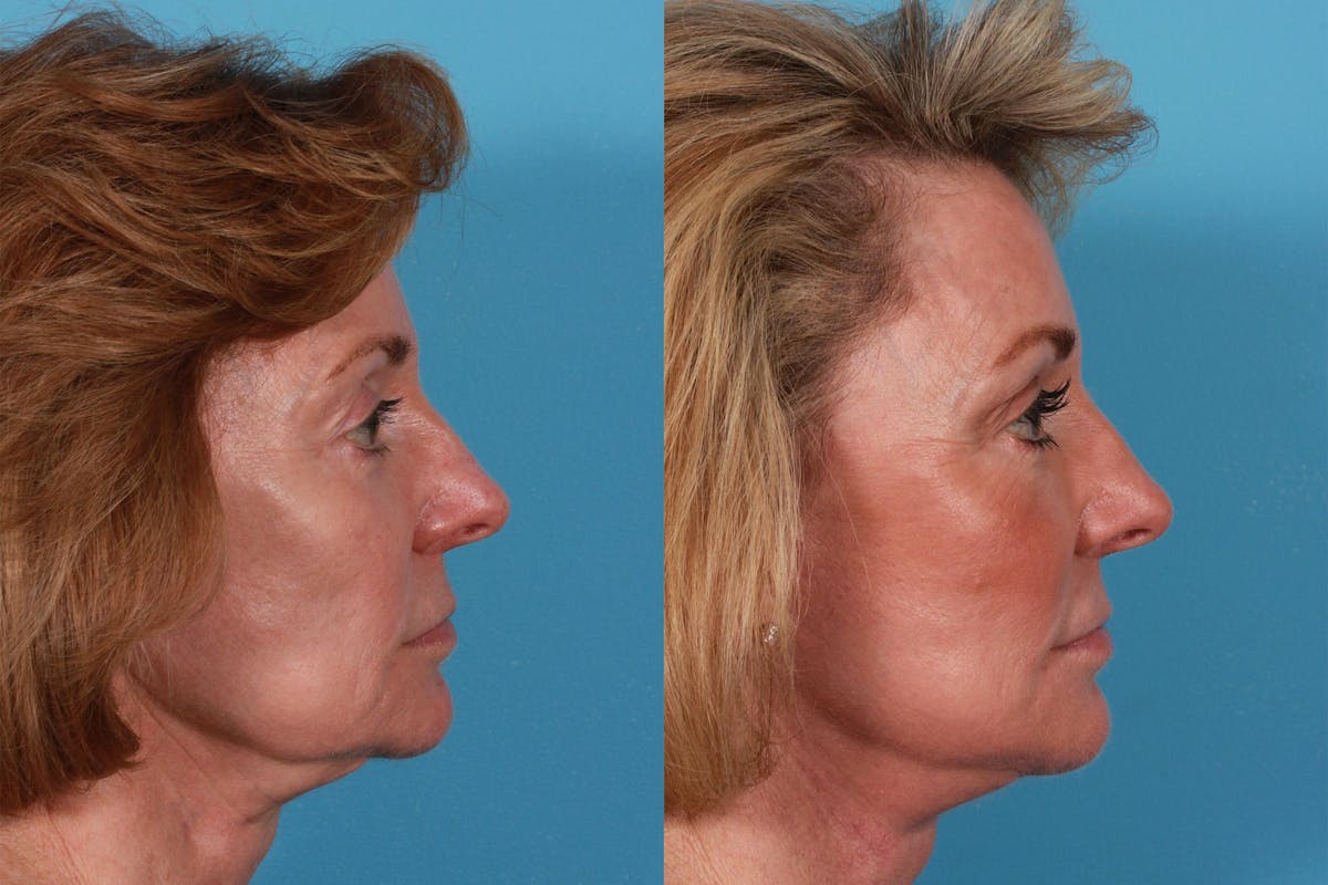 Facelift Before & After Gallery - Patient 325466 - Image 3