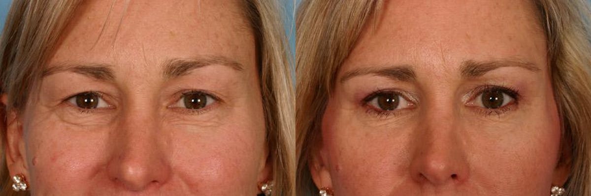 Eyelid Surgery (Blepharoplasty) Before & After Gallery - Patient 350327 - Image 4