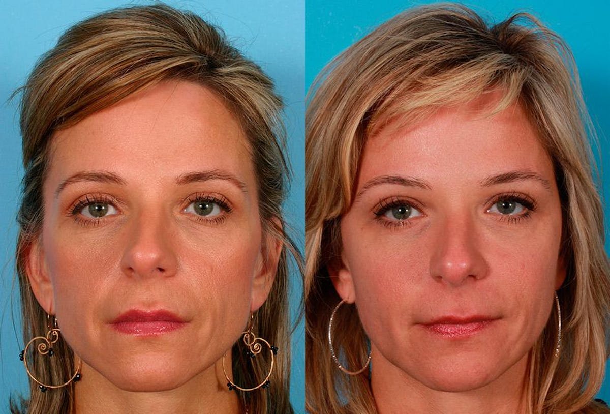 Sculptra Before & After Gallery - Patient 302081 - Image 1