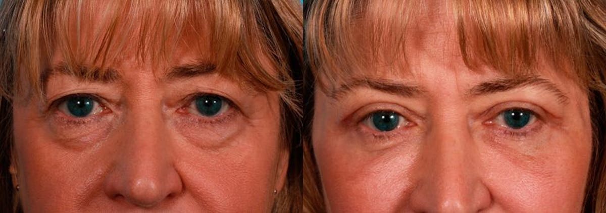 Facial Fat Transfer Before & After Gallery - Patient 869640 - Image 4