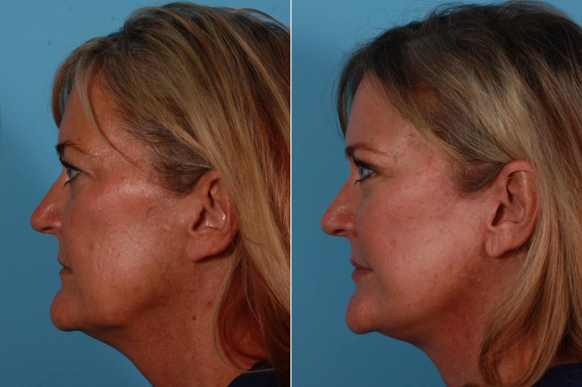 Lip Augmentation Before & After Gallery - Patient 220685 - Image 3