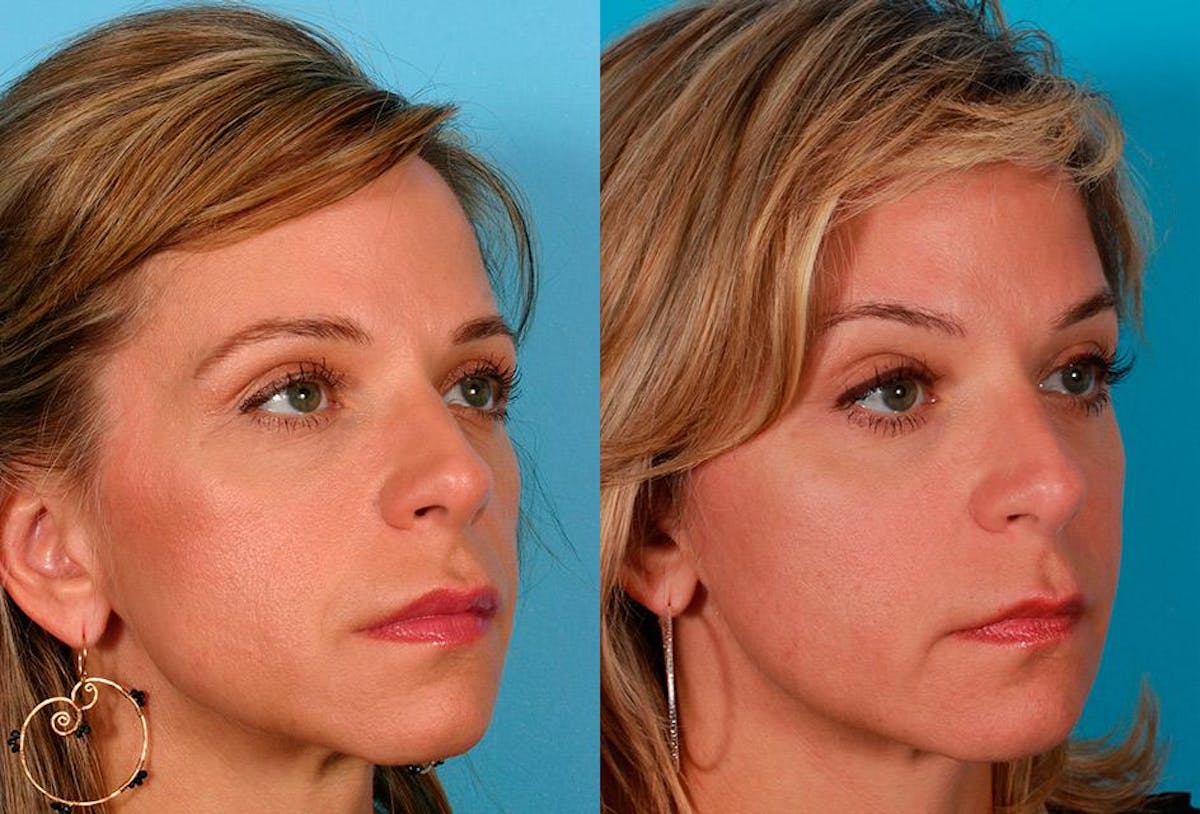 Sculptra Before & After Gallery - Patient 302081 - Image 2