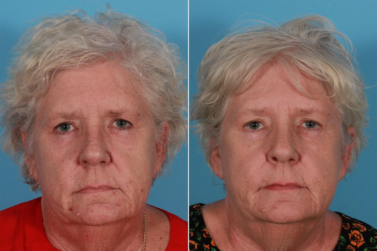 Lasers Before & After Gallery - Patient 326154 - Image 7