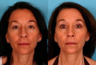 Rhinoplasty Before & After Gallery - Patient 125832 - Image 1