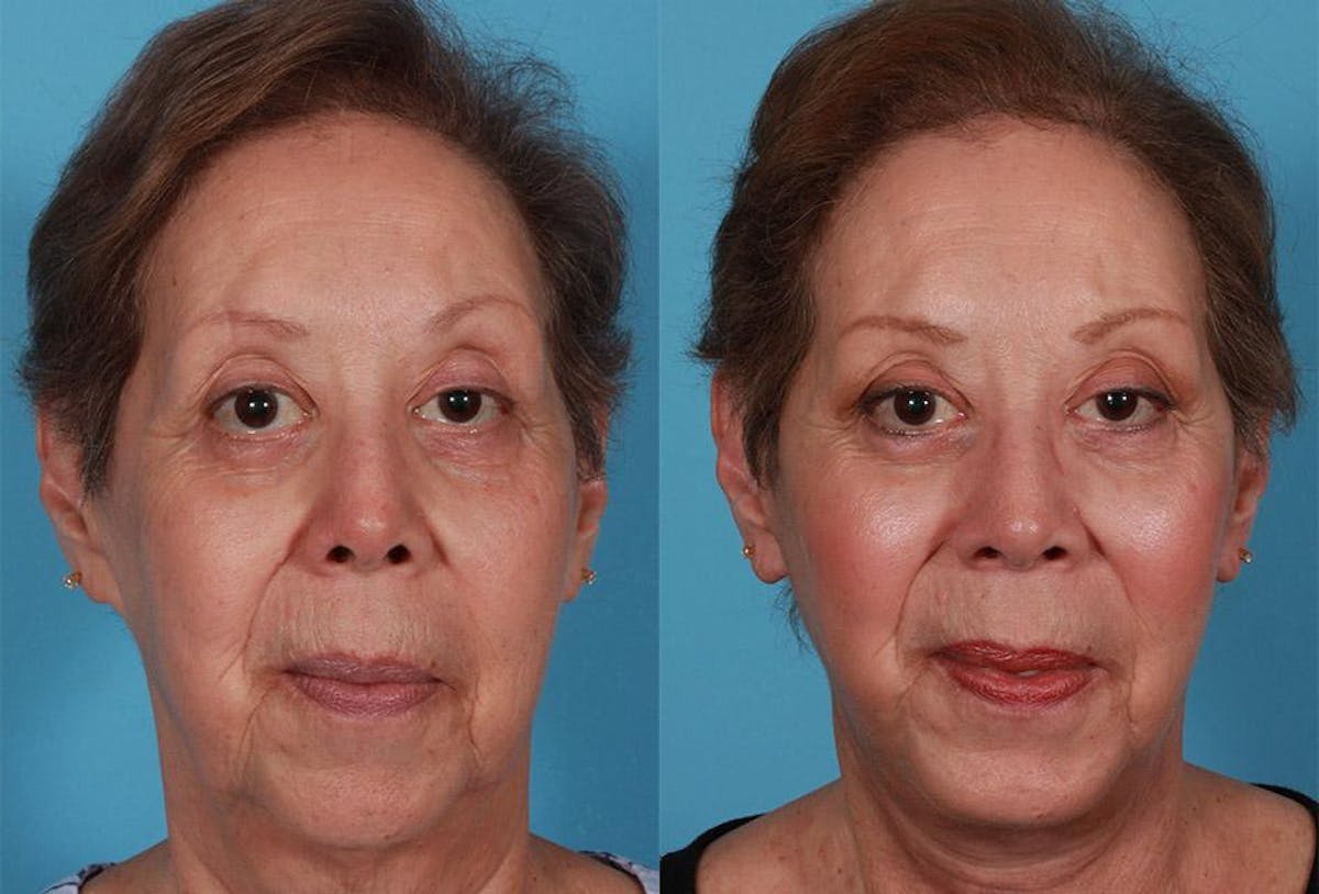 Facelift Before & After Gallery - Patient 175877 - Image 1