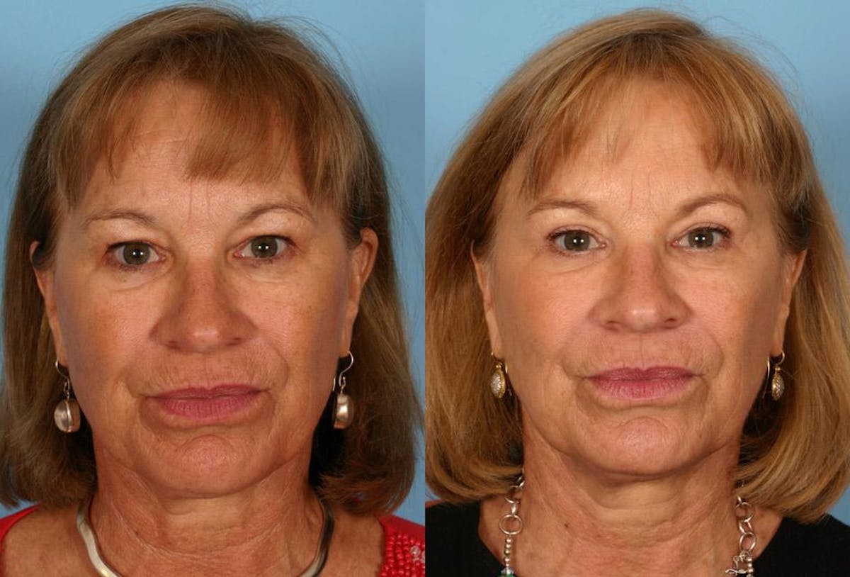 Eyelid Surgery (Blepharoplasty) Before & After Gallery - Patient 403639 - Image 1