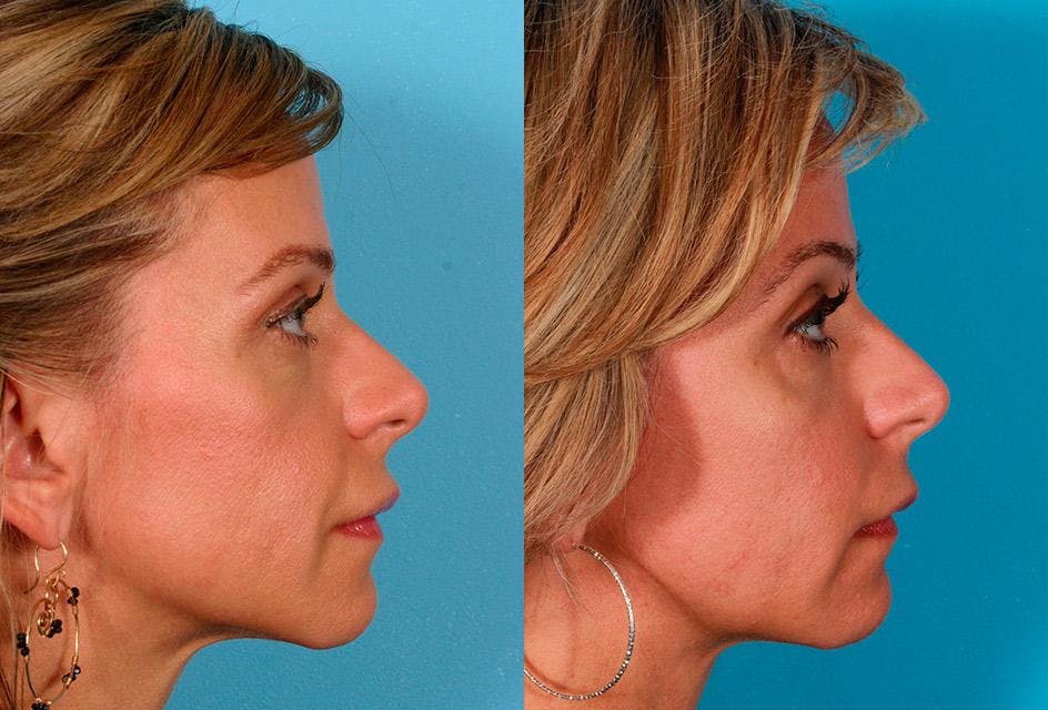Sculptra Before & After Gallery - Patient 302081 - Image 3