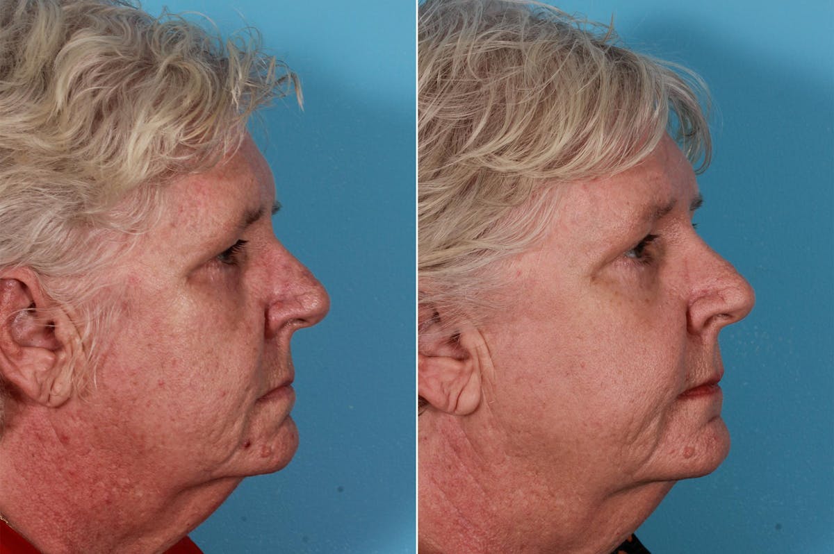 Lasers Before & After Gallery - Patient 326154 - Image 8