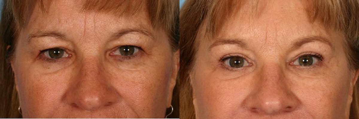 Eyelid Surgery (Blepharoplasty) Before & After Gallery - Patient 403639 - Image 2