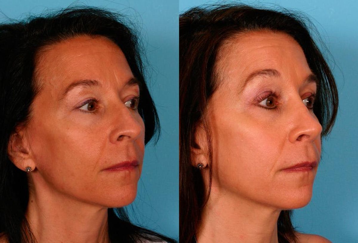Rhinoplasty Before & After Gallery - Patient 125832 - Image 2