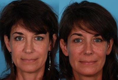 Sculptra Before & After Gallery - Patient 366467 - Image 1