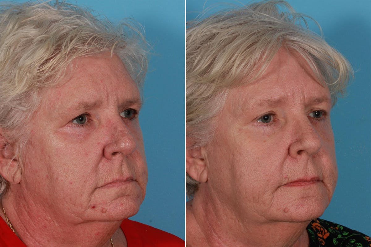 Lasers Before & After Gallery - Patient 326154 - Image 9