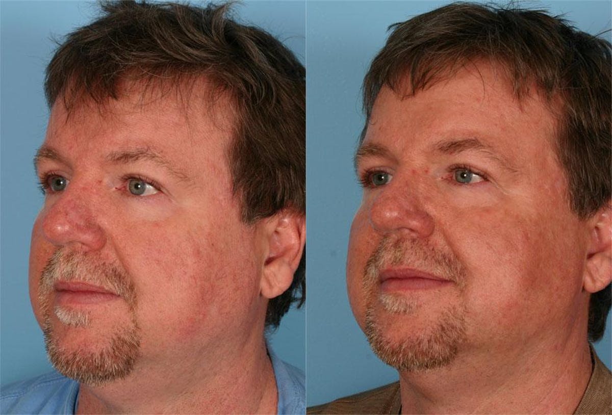 Rosacea Before & After Gallery - Patient 324414 - Image 1