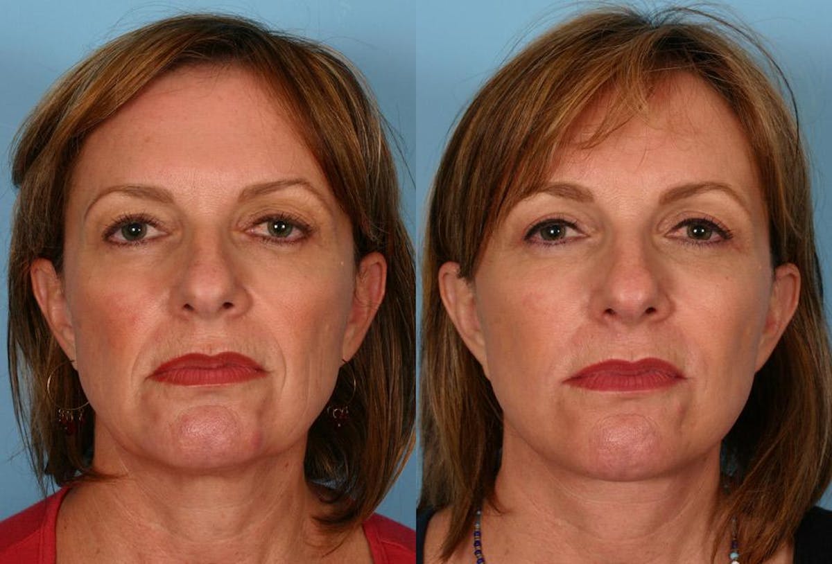 Eyelid Surgery (Blepharoplasty) Before & After Gallery - Patient 250574 - Image 1