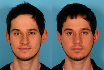 Rhinoplasty Before & After Gallery - Patient 402816 - Image 1