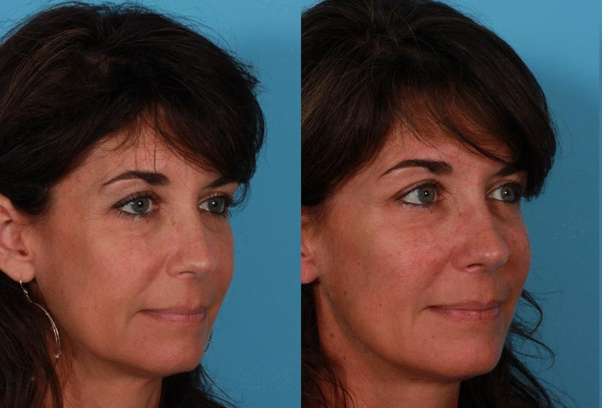 Sculptra Before & After Gallery - Patient 366467 - Image 2