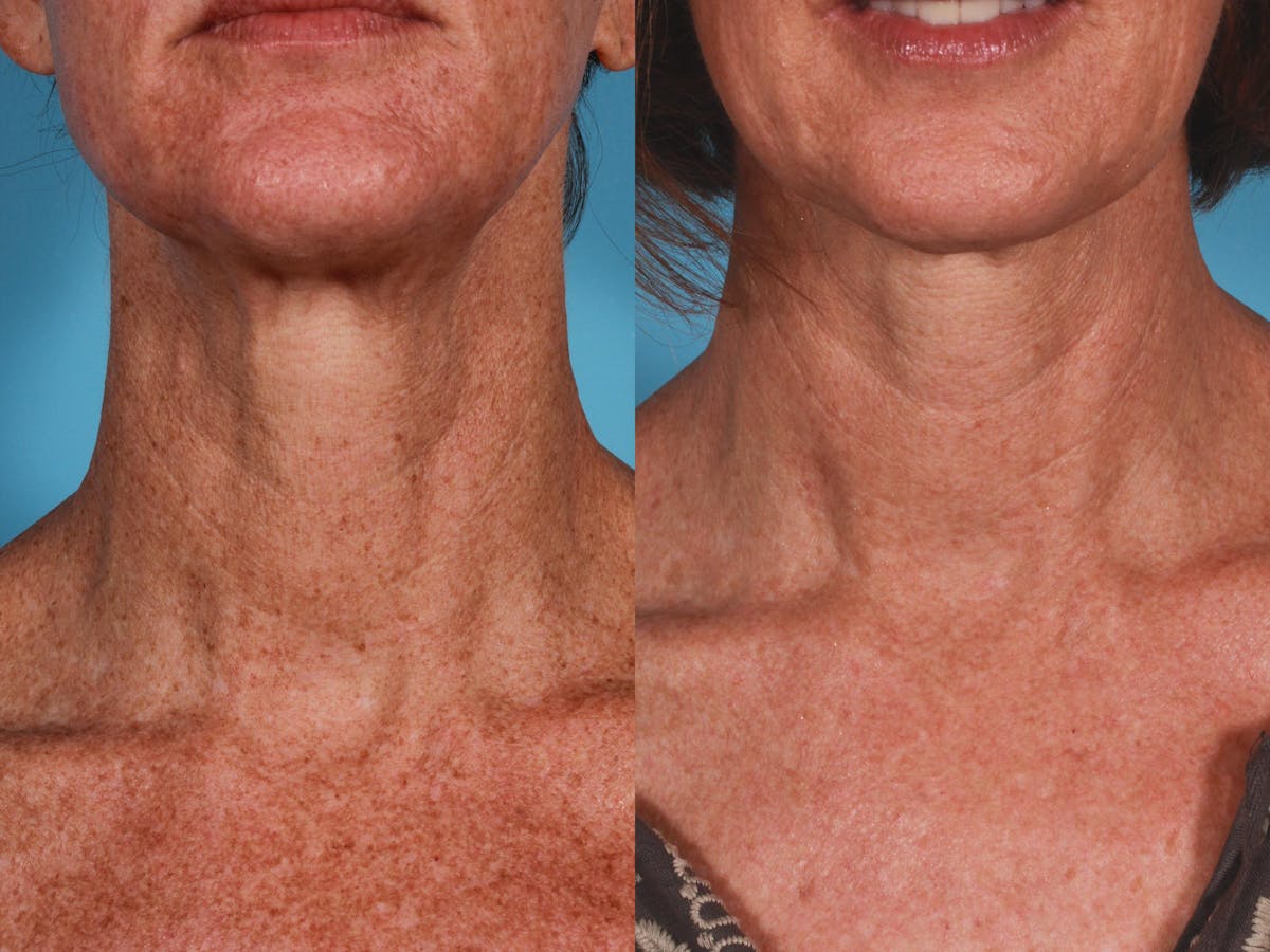 Lasers Before & After Gallery - Patient 125257 - Image 1