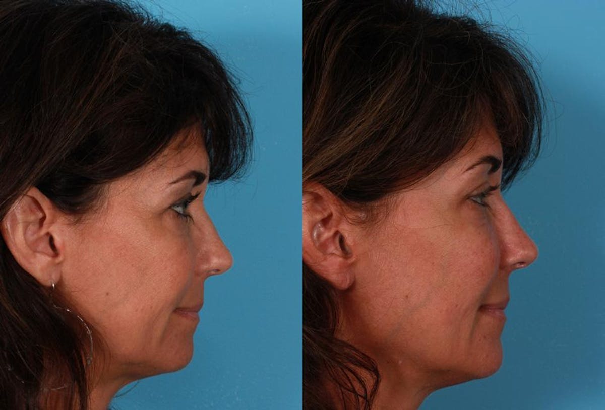 Sculptra Before & After Gallery - Patient 366467 - Image 3