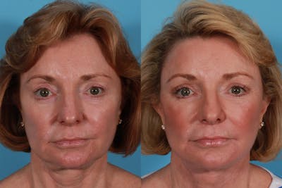 Facial Fat Transfer Before & After Gallery - Patient 419296 - Image 1