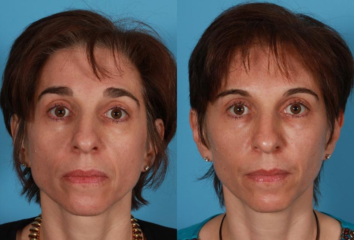 Sculptra Before & After Gallery - Patient 205144 - Image 1