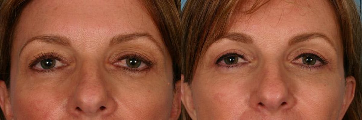 Eyelid Surgery (Blepharoplasty) Before & After Gallery - Patient 250574 - Image 4
