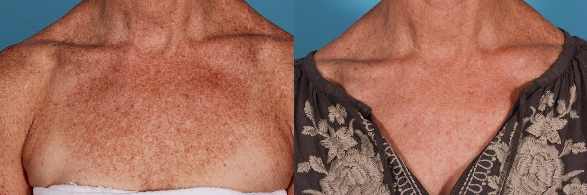 Lasers Before & After Gallery - Patient 125257 - Image 2