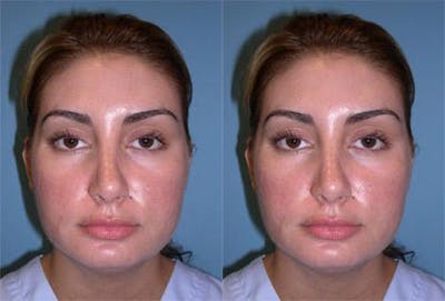 TCA Peel / Dermabrasion Before & After Gallery - Patient 432232 - Image 1