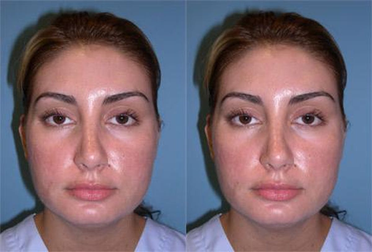 TCA Peel / Dermabrasion Before & After Gallery - Patient 432232 - Image 1