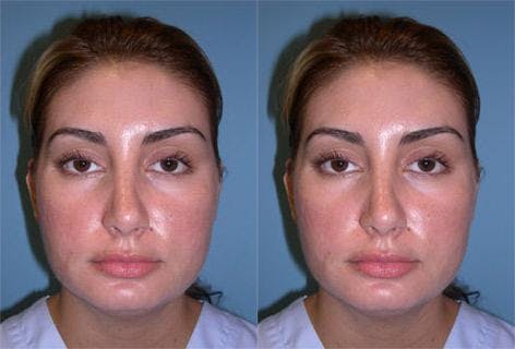 TCA Peel / Dermabrasion Before & After Gallery - Patient 432232 - Image 1