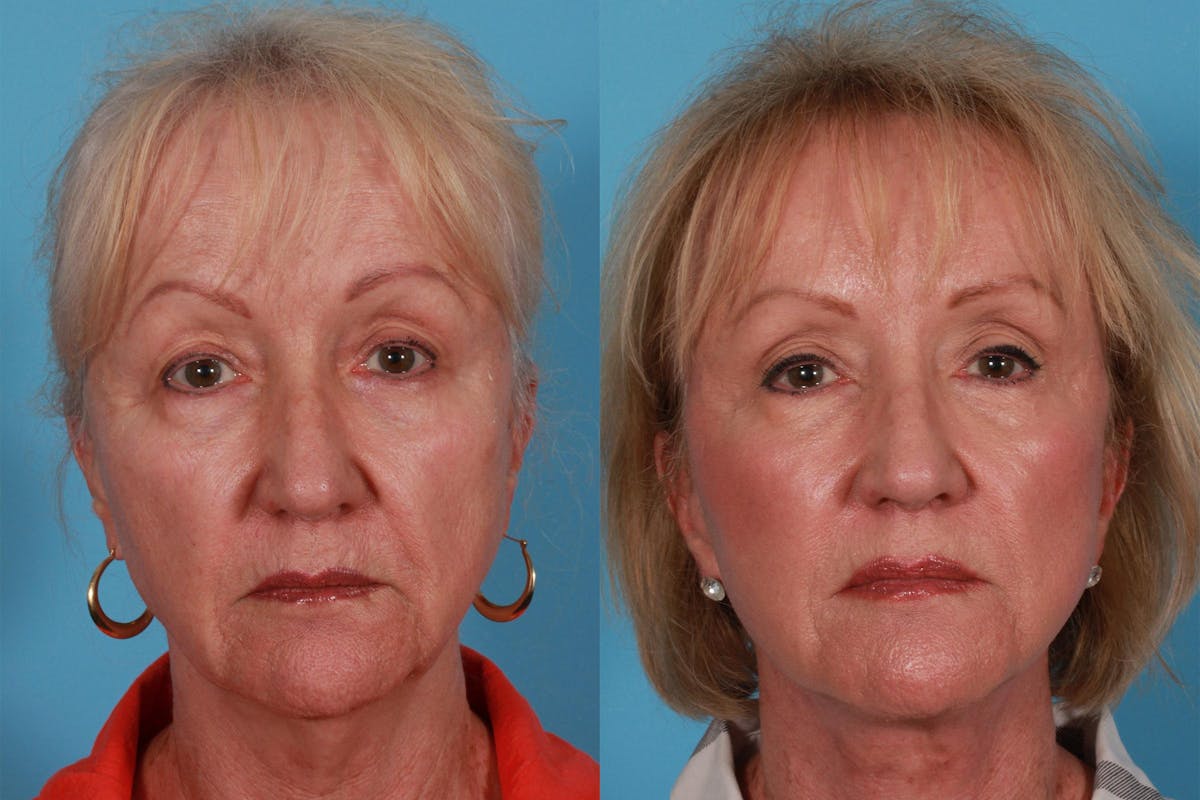 Facelift Before & After Gallery - Patient 415125 - Image 1