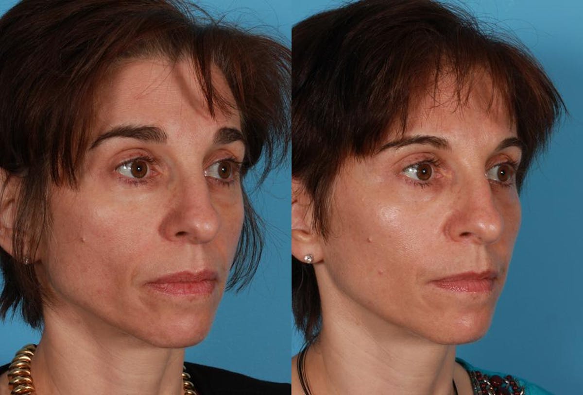 Sculptra Before & After Gallery - Patient 205144 - Image 2