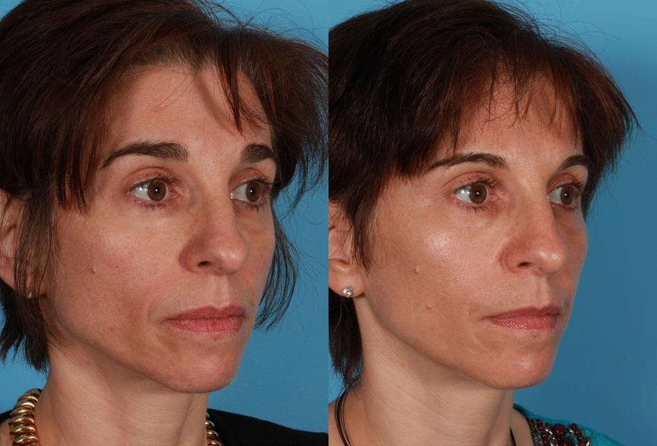 Sculptra Before & After Gallery - Patient 205144 - Image 2