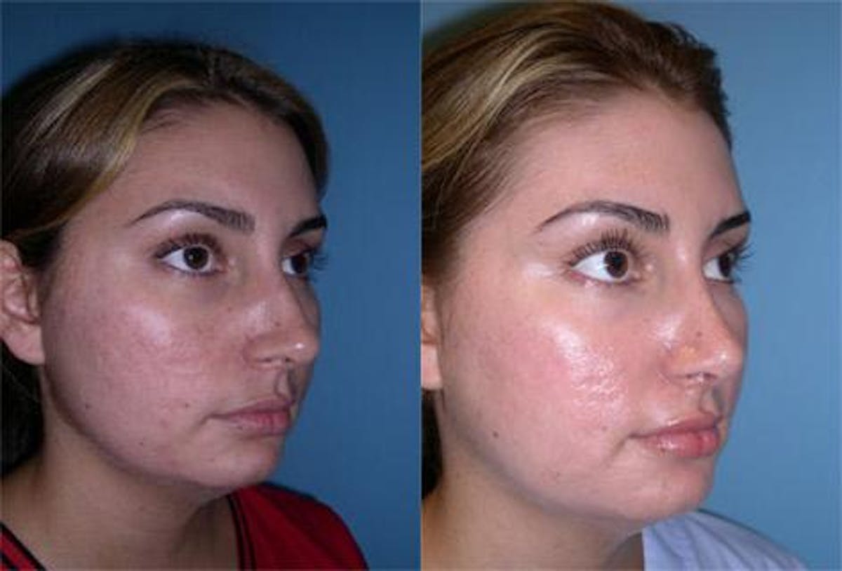 TCA Peel / Dermabrasion Before & After Gallery - Patient 432232 - Image 2