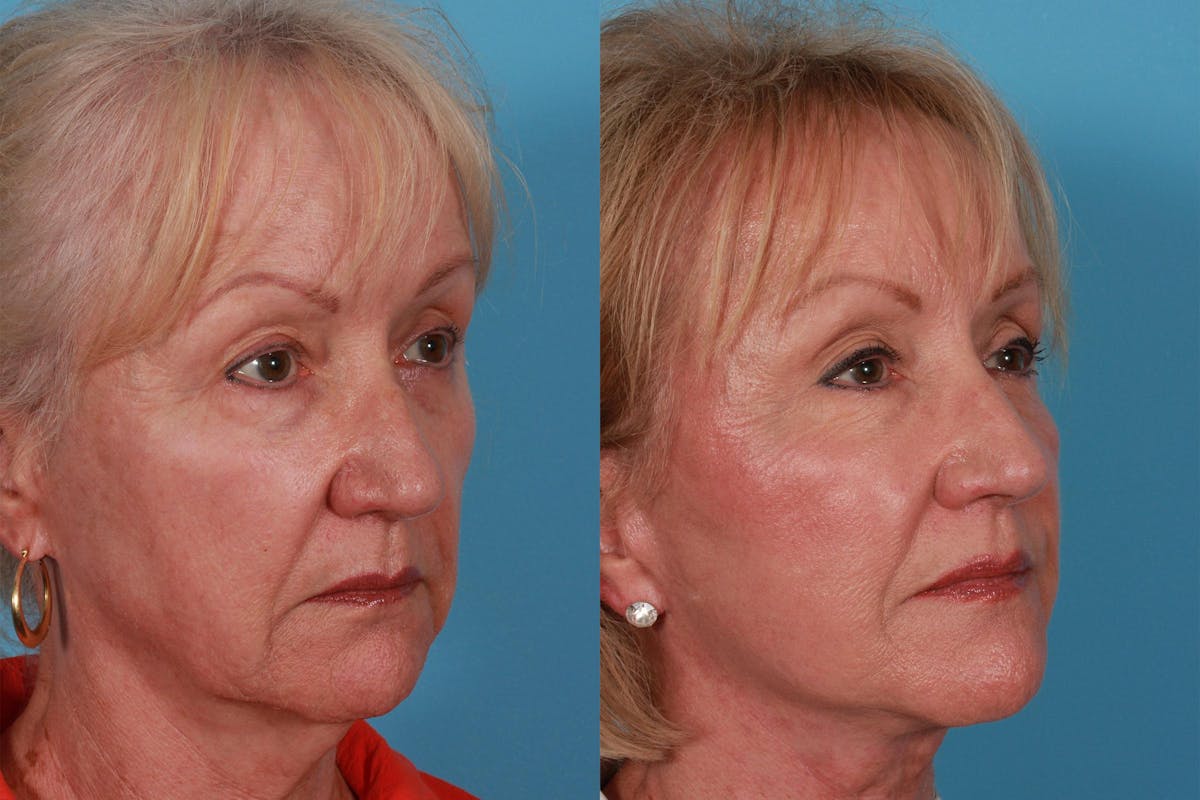 Facelift Before & After Gallery - Patient 415125 - Image 2
