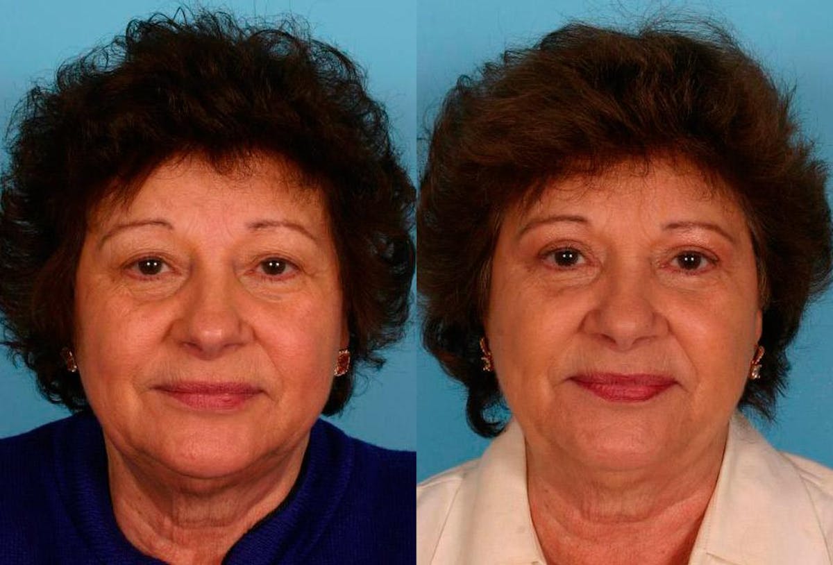 Eyelid Surgery (Blepharoplasty) Before & After Gallery - Patient 194674 - Image 1