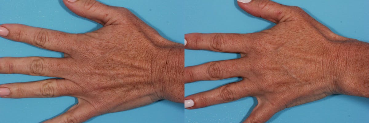 Lasers Before & After Gallery - Patient 125257 - Image 4