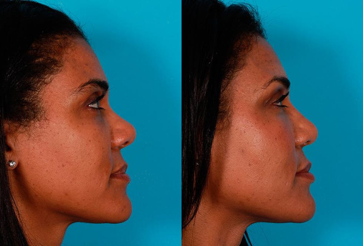 Rhinoplasty Before & After Gallery - Patient 174698 - Image 2