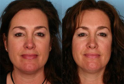 Rosacea Before & After Gallery - Patient 156214 - Image 1