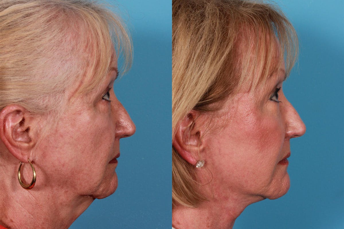 Facelift Before & After Gallery - Patient 415125 - Image 3