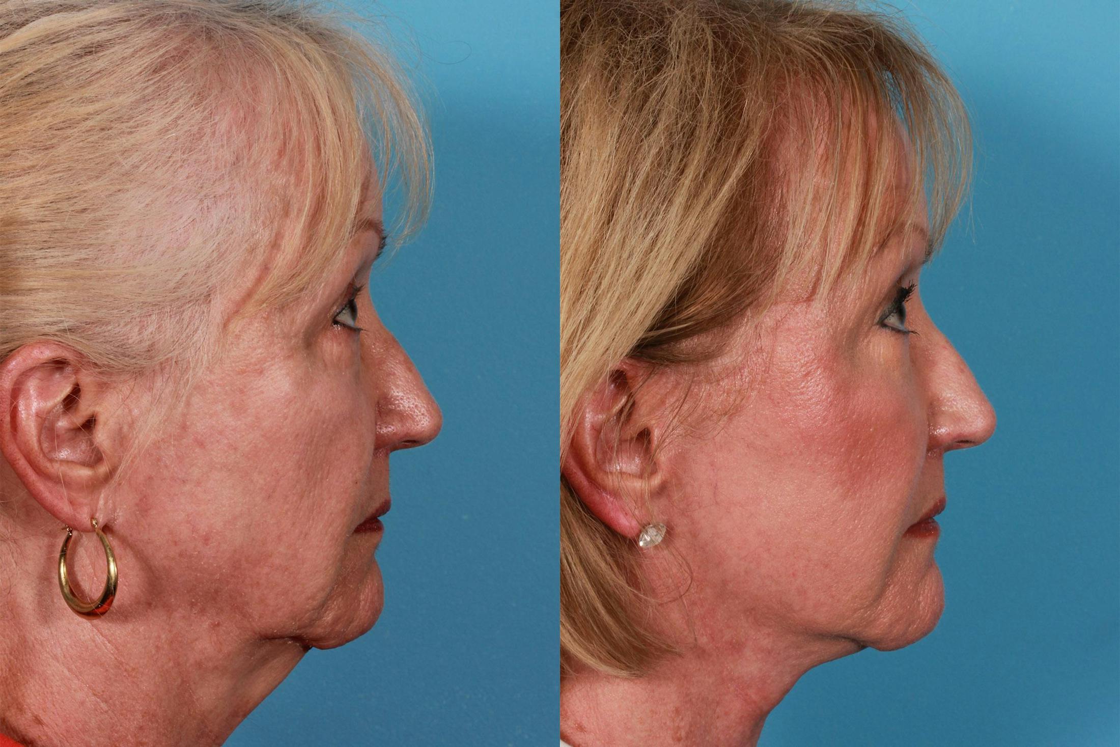 Facelift Before & After Gallery - Patient 415125 - Image 3